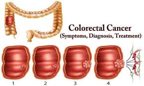 The 2 tests used for this are colonoscopy or ct colonography. Colorectal Cancer Symptoms Diagnosis Treatment Assignment Point