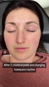 Acne chemical peel facials