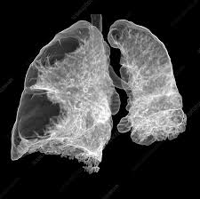 Image result for Emphysema