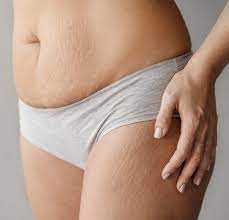80,000+ Stretch Mark Treatment Pictures