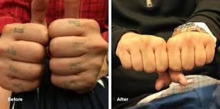 Once the laser breaks up the ink molecules in your tattoo, the lymphatic. Knuckle Tattoo Removal Results Case Study Removery