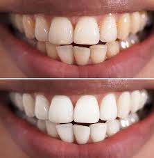 Teeth whitening Somerset West