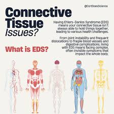 Image result for Connective Tissue Disorder