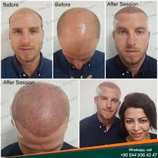 Best Hair Transplant Doctor In Turkey Dr Olcay Saygin Zen Hair Best Hair Transplant Hair Transplant Hair Transplant Results