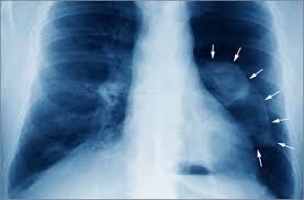 This website is designed primarily as an educational resource. Spotting The Signs Of Pneumothorax Independent Nurse