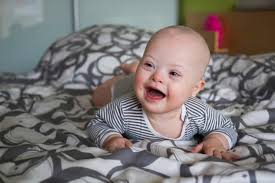 Ciri Ciri Down Syndrome Pada Bayi Dan Anak Yang Perlu Diwaspadai