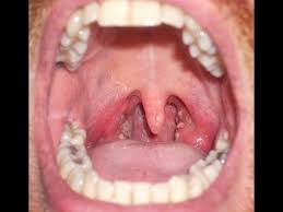 Strep throat is a contagious bacterial infection that develops in the throat. Sore Throat Or Strep Throat Youtube