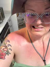 Remedies for wasp stings and allergic reactions