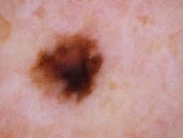 This kind of spot is referred to as lentigo simplex. Lentigo Simplex Dermnet Nz