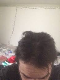 Estrogen is associated with healthy hair growth. I Got My Hair Back Thanks To Estradiol Hairlosstalk Forums