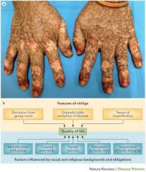 Image result for Vitiligo