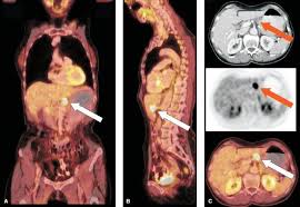 So i have had my mri today. Pancreatic Carcinoma Nuclear Oncology 1 Ed