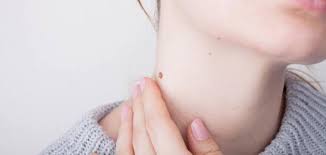 رمى طريقة شارة علاج الثآليل التناسلية عند الرجال بالثوم comertinsaat com