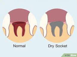 Maybe you would like to learn more about one of these? 4 Ways To Prevent Dry Socket After A Tooth Extraction Wikihow
