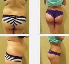 Le lipofiling ou la lipostructure, consiste en une procédure de transfert de graisse autologue lipofiling en tunisie, pour quel prix? Lipofilling Fesses Prix Augmentation Fesses