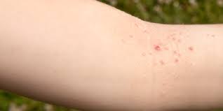 Image result for scabies bite