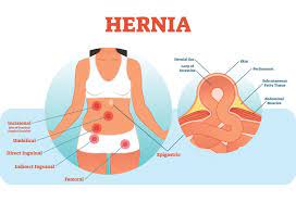 Hernia In Pregnancy Types Causes Symptoms Treatment