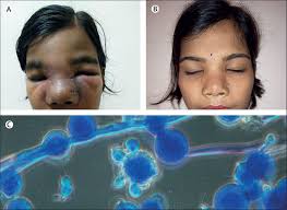 A deadly black fungus is rotting the organs and limbs of covid patients in india.most patients with picture of the fungal infection mucormycosis affecting someone's eye. Subcutaneous Fungal Infection Of The Face The Lancet Infectious Diseases