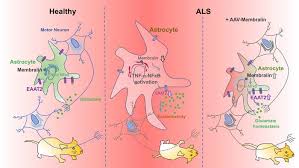 Als is a relentlessly progressive disorder. Jci Membralin Deficiency Dysregulates Astrocytic Glutamate Homeostasis Leading To Als Like Impairment