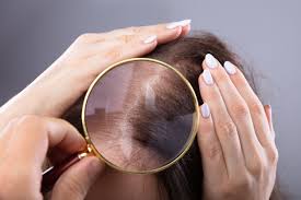 Ashwagandha intake per day for stress can vary from 125gms, 150 gms, or 200 gms, depending on the intensity of the case. Stress Induced Hair Loss Benefits From A Standardized Nutraceutical Naturopathic Doctor News And Review