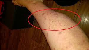 We did not find results for: How To Get Rid Of Eczema Scars On Body Youtube