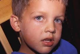 Image result for Postinflammatory Hypopigmentation