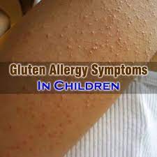Gluten Allergy Symptoms In Child And Relief Techniques Ehealthyblog Complete Health Informat Gluten Allergies Symptoms Food Allergy Symptoms Gluten Allergy