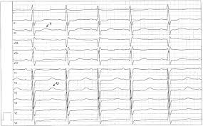 Erworbene Qt Qtc Verlangerung Und Torsade De Pointes Fokus Ekg