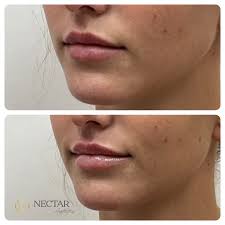 Nectar Aesthetics Med Spa