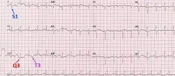 • blocco di branca destra di nuova insorgenza • deviazione assiale destra • p • ecg normale non esclude diagnosi di embolia polmonare. S1q3t3 Pattern On Ecg In Pulmonary Embolism