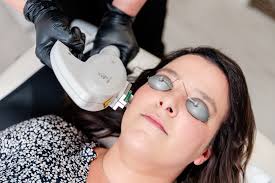 Skin Laser Treatments in San Angelo