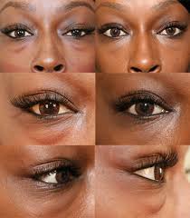 Oriental upper eyelid surgery, or asian double eyelid surgery or oriental. Brow Lift Eye Lift Before Afters Spalding Drive