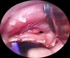This is the second time this has happened. Cureus Orbital Cellulitis Secondary To Dental Abscess In Children