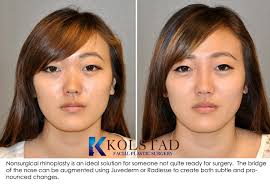 Best Asian Rhinoplasty With Injectable Dermal Filler In La Jolla 12 Dr Kolstad San Diego Facial Plastic Surgeon