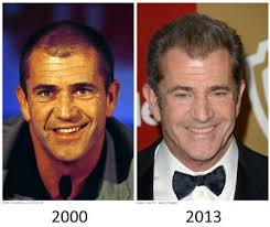 Mel Gibson Plastic Surgery Hair Transplant Hair Loss Men Male Pattern Baldness Hair Transplant