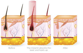 According to the american society of plastic. Choose Diode Laser Hair Removal Machine Dimyth
