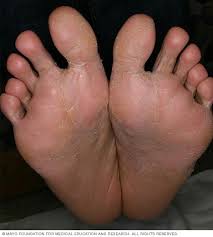Image result for pompholyx soles of feet
