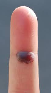 Wash your hands and the blister with soap and warm water. Blood Blister Symptoms Causes Diagnosis
