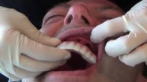 While having all of your teeth pulled at once can seem like something nobody wants to go through, a lot of the time it's for your best interest and to provide you. Denture Services And Dentures In Lexington Ky