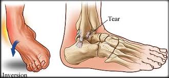 The ligament is not connected to the lateral meniscus in the joint and so unlike medial ligament injuries, they are not normally associated with meniscal tears. Acute Chronic And Recurrent Ankle Sprains Kingsley Physio More Than Your Local Physio