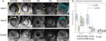 Comprehensive cardiac magnetic resonance imaging in patients with suspected myocarditis: Ferumoxytol Enhanced Cardiovascular Magnetic Resonance Detection Of Early Stage Acute Myocarditis Journal Of Cardiovascular Magnetic Resonance Full Text