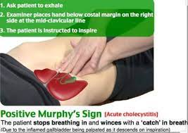 A positive murphy's sign in a patient with right upper quadrant abdominal pain is the arrest of inspiration during deep palpation of the quadrant. Murphy S Sign Liver