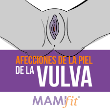 Como Pueden Afectar Las Afecciones Dermatologicas De La Vulva Al Suelo Pelvico Mamifit Es