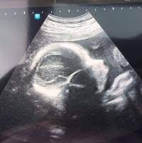 Ssw bin, bin ich etwas irritiert. 27 Ssw Wie Fuhlen Sich Ubungswehen An Zeigt Eure Ultraschallbilder Urbia De