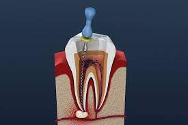 √ fast and easy to use. Why You Shouldn T Be Scared Of Getting A Root Canal Thomas F Plunkett Dmd Pa Lakeland Florida