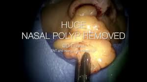 Nasal polyps grow in inflamed tissue of the nasal mucosa. Huge Nasal Polyp Removal Youtube