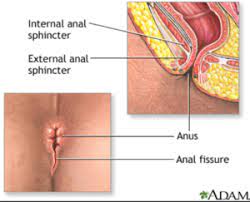 Anal fissures are treatable - San Francisco AIDS Foundation