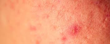Image result for genital herpes