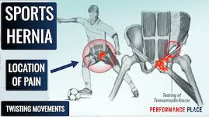 Groin is made of multiple ligaments, muscles, and tendons which fuse together in the pubic bone. 2021 12 Truths About Your Sports Hernia Your Doctor Didn T Tell You