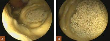 Then in this chicken, an additional infection can occur in the following days. Avian Aspergillosis What Every Veterinarian Needs To Know Today S Veterinary Practice